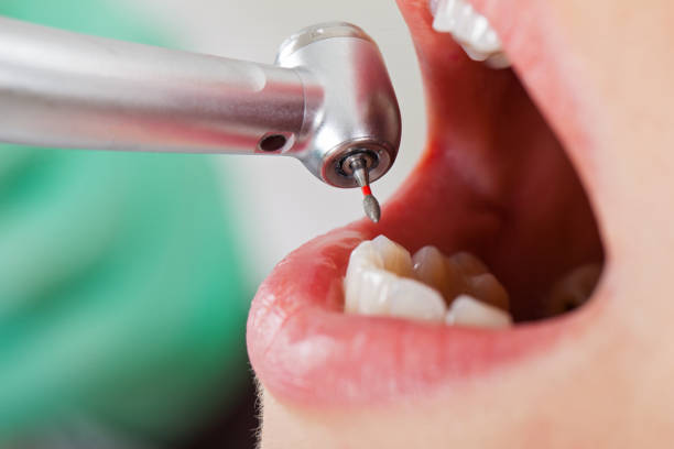 Best Emergency Dental Care for Abscessed Tooth in Red Bluff, CA